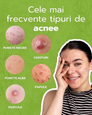 O, ACNEE! 😩 Acneea afectează aproape fiecare femeie din când în când. 😬 Cheia este să recunoști ce tip de acnee ai. Te...